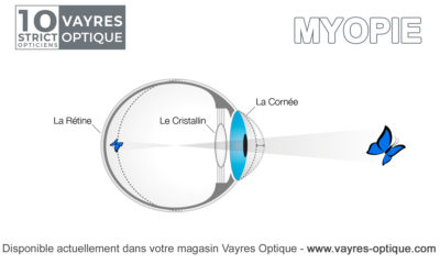 Information sur la Myopie